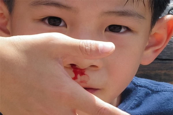 
Các chuyên gia khuyến cáo, không nên cho trẻ ngửa cổ lên hoặc cúi gằm xuống khi đang bị chảy máu cam. Ảnh minh họa
