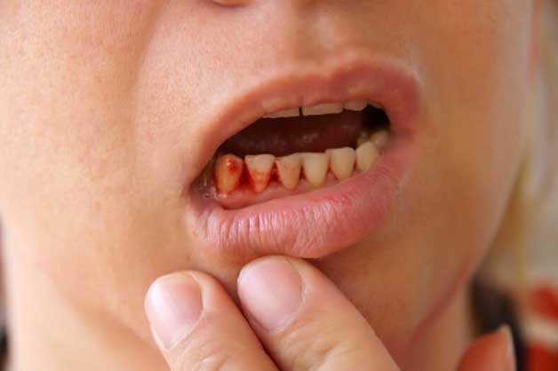 Chảy máu chân răng cảnh báo nhiều căn bệnh nguy hiểm không thể bỏ qua
