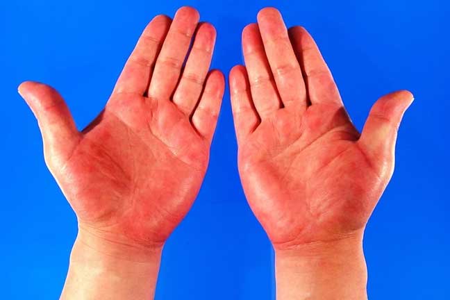 Thấy có những dấu hiệu này ở bàn tay hãy nhanh đi gặp bác sĩ vì có thể bạn đã mắc bệnh nguy hiểm