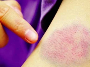 Nhìn thấy dấu hiệu này có thể bạn đang đối mặt ung thư máu, đi khám ngay đừng chủ quan