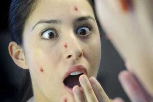 Khi thấy mụn mọc vị trí này hãy đi khám ngay kẻo ung thư giai đoạn cuối lúc nào chẳng biết