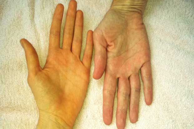 Những dấu hiệu chứng tỏ gan bị tổn thương nghiêm trọng, nên đến bệnh viện kiểm tra sớm càng tốt tránh hối hận