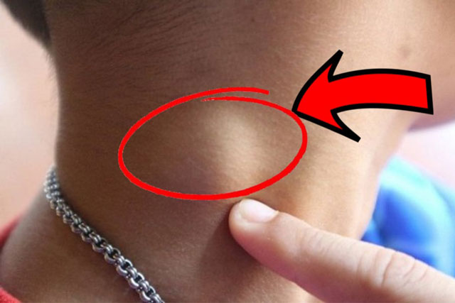 Người sắp bị K tấn công thường có 3 dấu hiệu lạ ở cổ, có 1 cái thôi đã là báo động