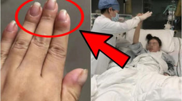 Ngón tay sưng to, cô gái điếng người khi biết bệnh K đã chuyển nặng