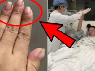 Ngón tay sưng to, cô gái điếng người khi biết bệnh K đã chuyển nặng