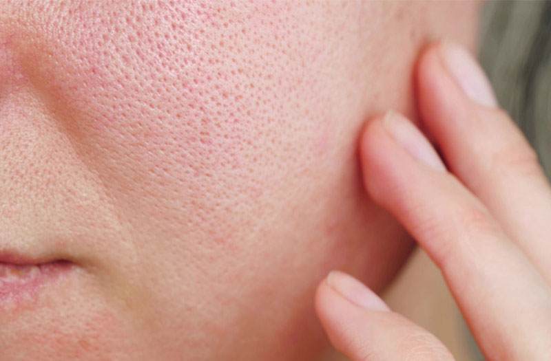 Cách làm đá viên hoa hồng thu nhỏ lỗ chân lông