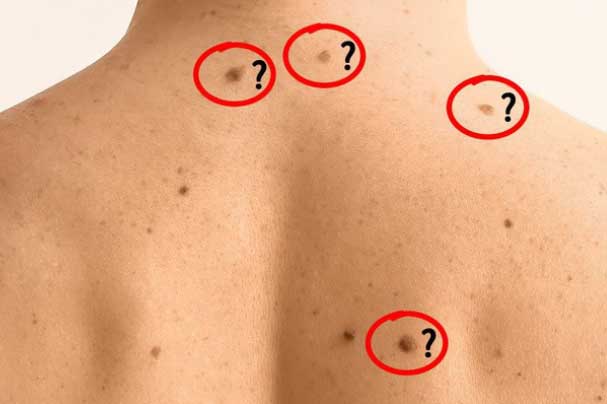 Dấu hiệu thay đổi bất thường của nốt ruồi cảnh báo căn bệnh nguy hiểm, nguy cơ bị ung thư cao