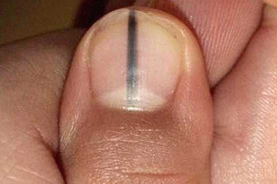 Thấy 4 điểm này càng 'đen': Hãy thận trọng ung thư gan đang “tấn công” cơ thể bạn