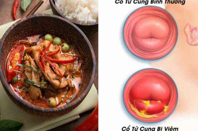 5 thực phẩm 'nuôi' khối u xơ lớn mỗi ngày, là mối nguy hại với tử cung