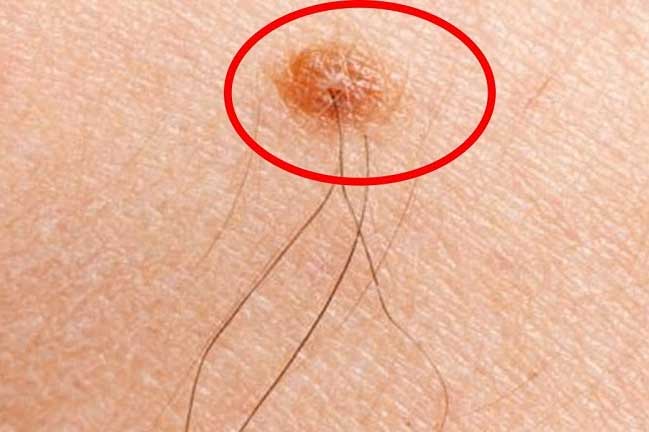 5 dấu hiệu nhiều người gặp cứ lầm tưởng bản thân đang bị ung thư nhưng thực tế lại thế này