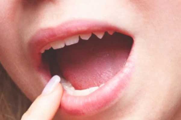 Xuất hiện triệu chứng này trong khoang miệng, hãy đi khám ngay bởi bệnh ung thư đã đến rất gần