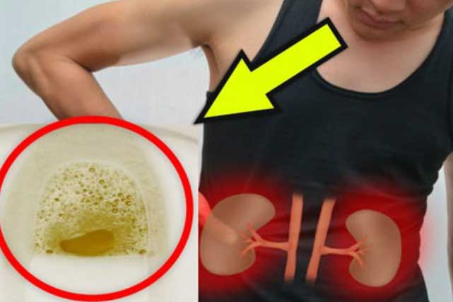 Thấy nước tiểu chuyển sang màu này, hãy cẩn thận vì căn bệnh nguy hiểm đang "gõ cửa"