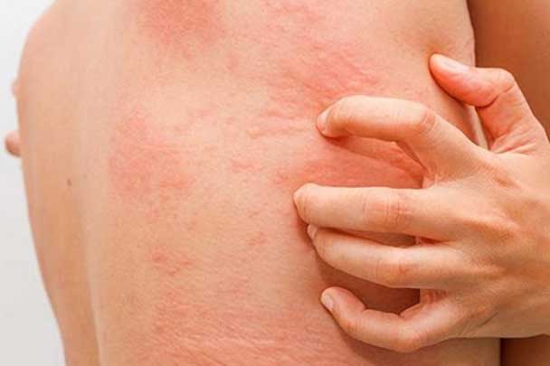 Thấy dấu hiệu nhỏ này trên cơ thể chứng tỏ gan đang yếu đi mỗi ngày, chứ dại mà coi thường kẻo mang hoạ