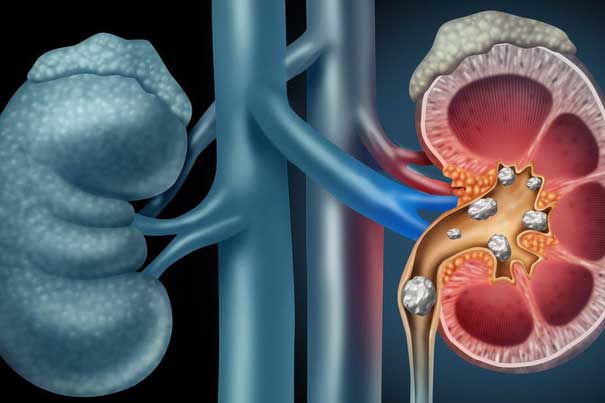 5 nguyên nhân hàng đầu gây suy thận nặng, nhiều người Việt vô tư làm mà không biết để tránh