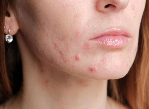 Điều cần lưu ý khi bị mụn trứng cá đỏ