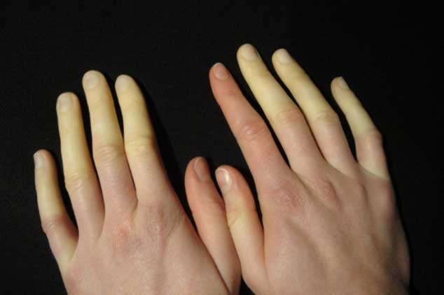 Nếu thấy dấu hiệu này, bạn đang mắc 1 bệnh ung thư vô cùng nguy hiểm đấy – Hãy đi khám ngay