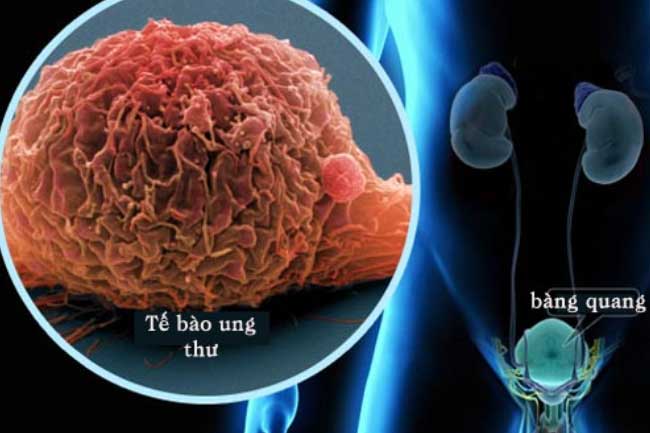 5 dấu hiệu cảnh báo ung thư đang tấn công cơ thể, rất hay bị nhầm lẫn với bệnh thông thường