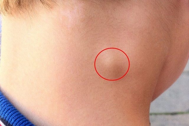 4 dấu hiệu lạ ở cổ cảnh báo tế bào K tấn công cơ thể