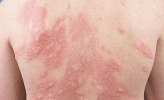 Cần làm gì khi bị nổi mề đay?