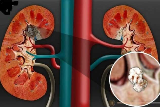 Thầy thuốc Đông y chia sẻ bài thuốc quý nạo sạch sỏi thận, trị dứt điểm trong vòng 1 tuần