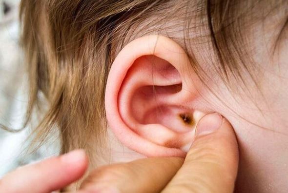 Phòng bệnh viêm tai giữa ở trẻ em