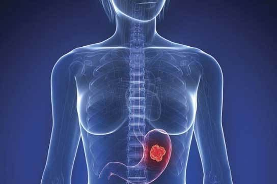 Dấu hiệu cảnh báo bệnh ung thư dạ dày sớm nhất