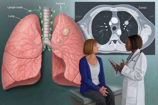 Muốn ngừa ung thư nhất định phải làm 3 việc đơn giản này nhưng nhiều người thường biết quá muộn