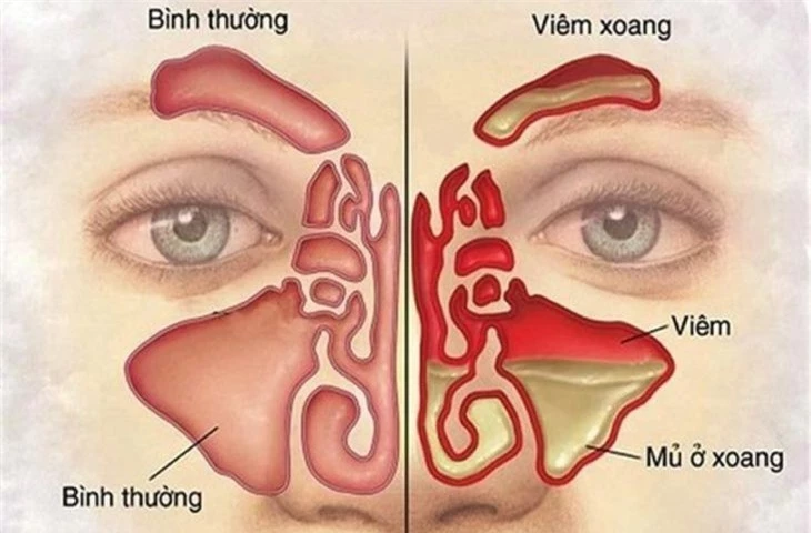 Dấu hiệu nhận biết bệnh viêm xoang và cách phòng tránh ảnh 1