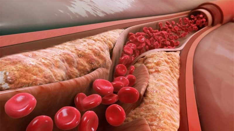 Thực phẩm giúp giảm lipid máu