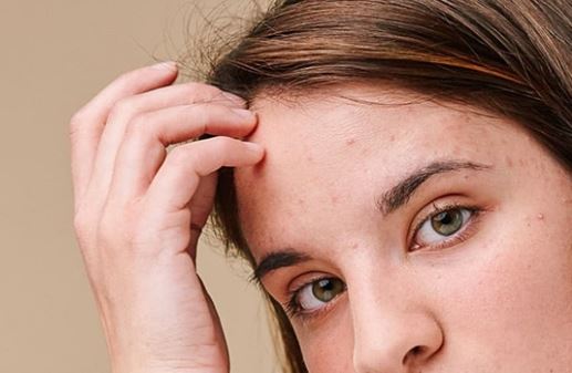 Cách kiểm soát mụn cho da dầu vô cùng hiệu quả