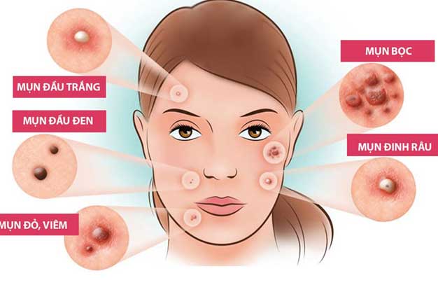 5 nguyên nhân chẳng ngờ đến khiến mụn cứ mọc đi mọc lại ở cùng một vị trí, bất ngờ với số 3