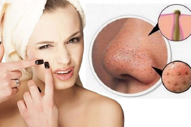 6 điều cần chú ý khi trị mụn đầu đen tránh làm tổn thương da mặt