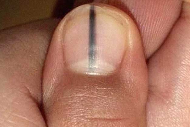 Móng tay có đường kẻ sọc đen, uống ngay loại thức uống này để giải độc cho cơ thể trước khi quá muộn