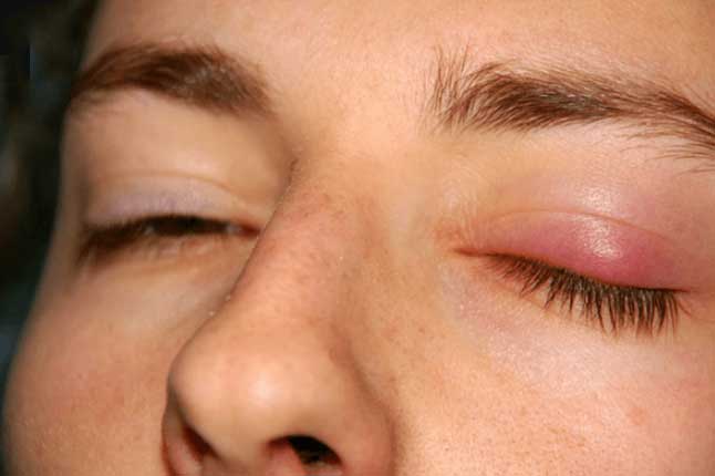 Nhìn vào mắt 5 giây: Nếu thấy dấu hiệu này xuất hiện hãy đi khám xem thận có bị suy yếu không