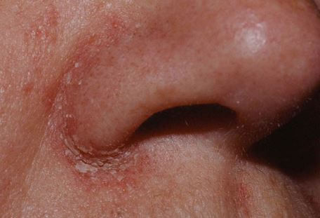 Dấu hiệu nhận biết bệnh viêm da tiết bã nhờn