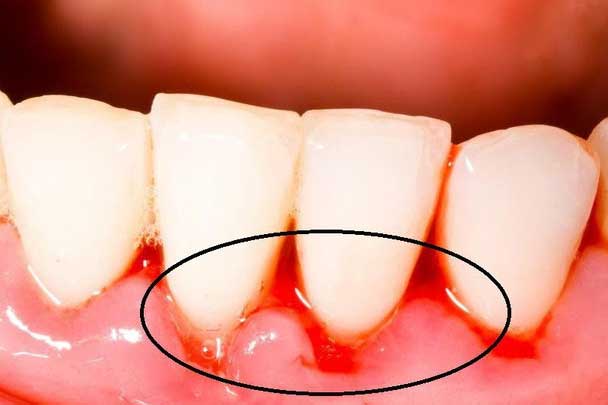 6 triệu chứng bất thường ở răng miệng cảnh báo nhiều vấn đề nguy hại, đặc biệt là cái số 1