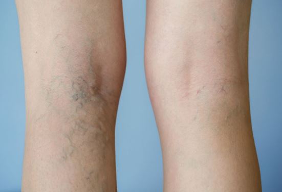 Cách phòng ngừa suy giãn tĩnh mạch