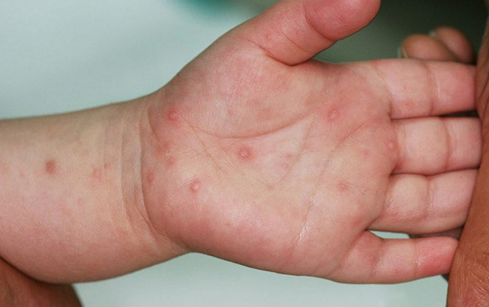 Những điều bạn cần biết về bệnh tay chân miệng ở trẻ nhỏ
