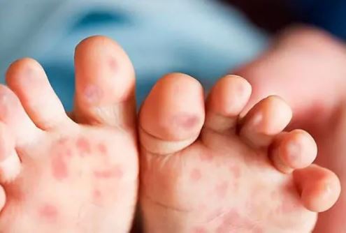 6 sai lầm cha mẹ hay mắc phải khi chăm sóc trẻ bị tay chân miệng