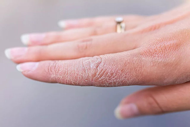 Làm thế nào để chăm sóc làn da khô hiệu quả?