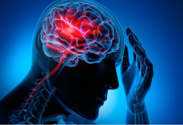 1 dấu hiệu của đột quỵ có thể xảy ra trước đó 90 ngày