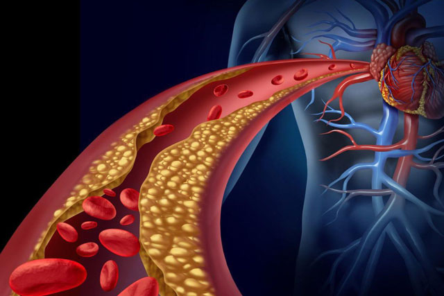 Bàn chân xuất hiện 4 dấu hiệu này, cẩn thận mỡ máu tăng cao bất thường