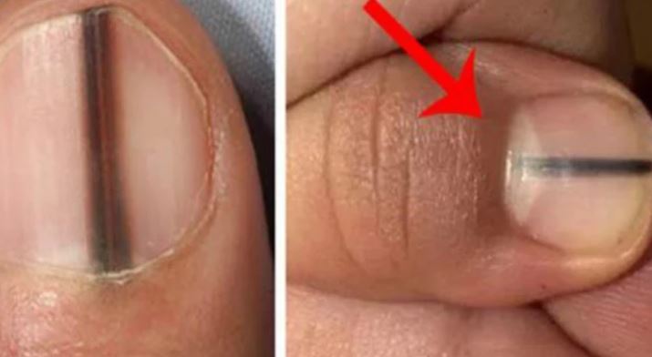 Móng tay xuất hiện sọc đen này, hãy đến gặp bác sĩ ngay lập tức