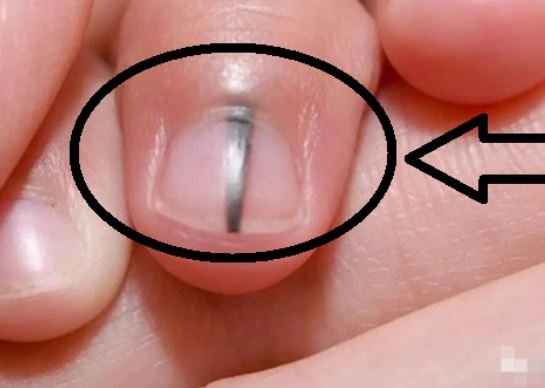 4 vùng trên cơ thể chuyển màu đen, cảnh báo hỏng gan lúc nào không biết