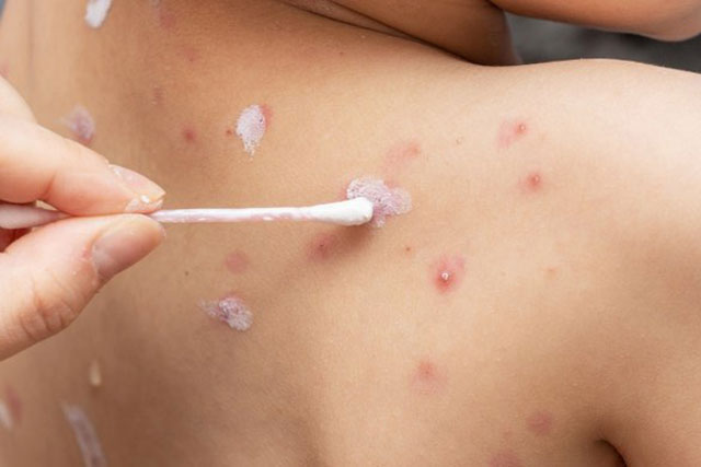 Thời tiết thay đổi, cẩn trọng bệnh sởi, thủy đậu ở trẻ nhỏ