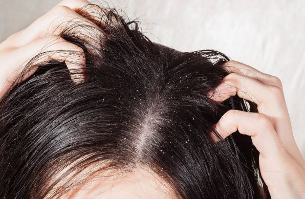 3 công thức trị gàu trong mùa hè hiệu quả
