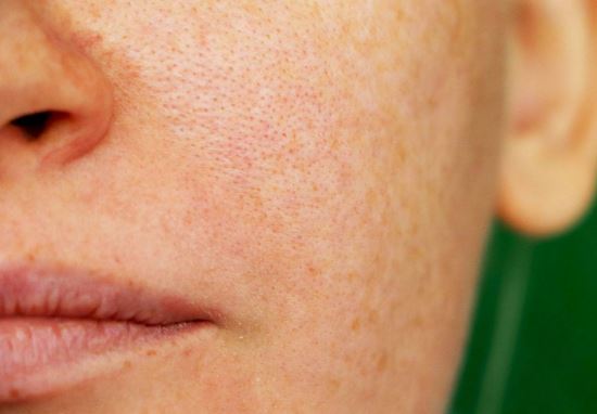 Khắc phục tình trạng da sần sùi hiệu quả