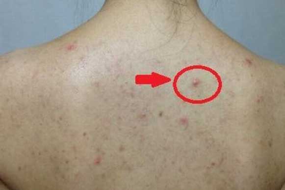 Thấy lưng mọc nhiều mụn, hãy cảnh giác với lời "báo động đỏ" từ cơ thể