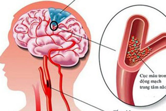 Dấu hiệu khi bạn bị thiếu máu não