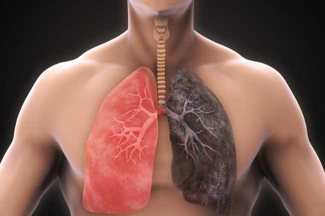 5 dấu hiệu cảnh báo ung thư phổi đang gõ cửa, nguy hiểm khó lường